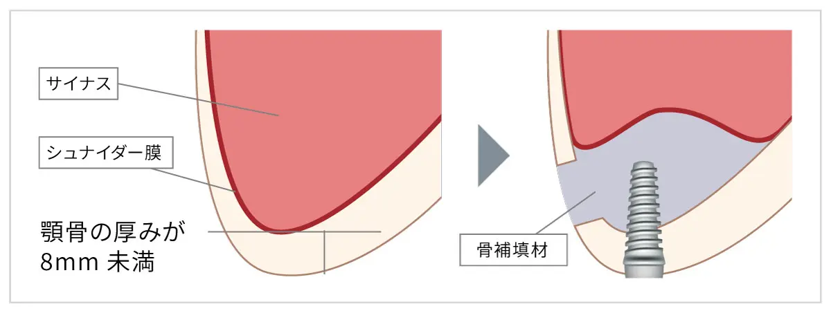 サイナスリフト（上顎洞底挙上術）とは - 糟屋郡インプラント歯科